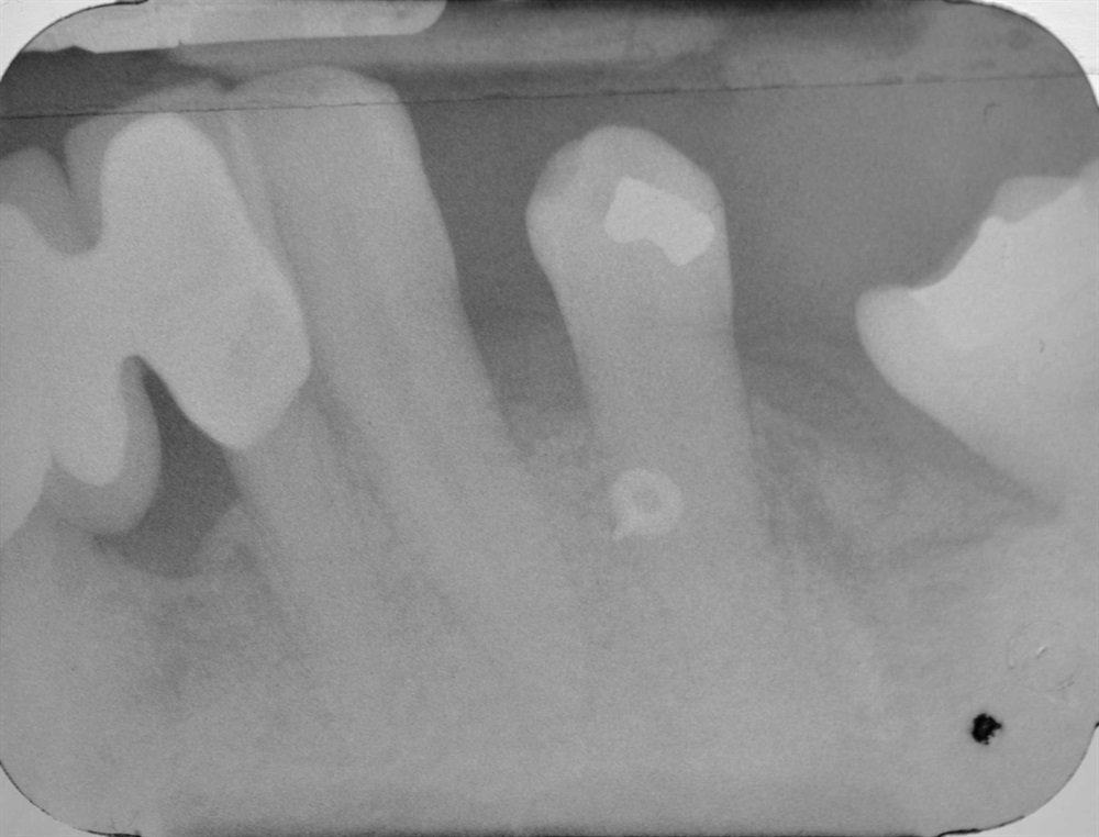 Tarquini_Periodontal intrabony defect